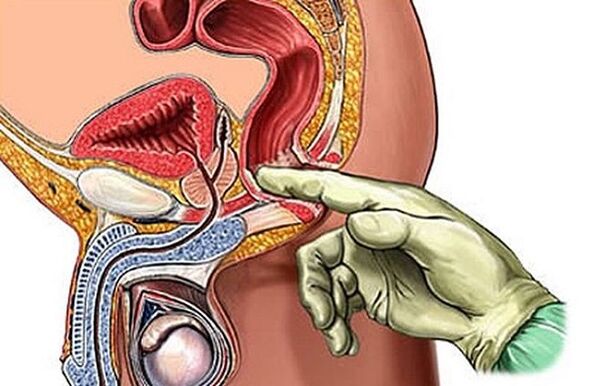Prostatamassage zur Behandlung von Prostatitis.