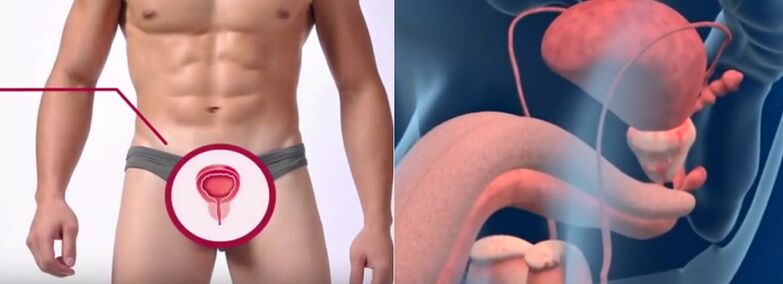 Prostatitis bei Männern, erkennbar an bestimmten Anzeichen.