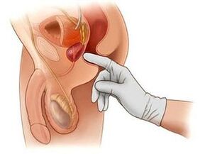 Prostatamassage bei Prostatitis