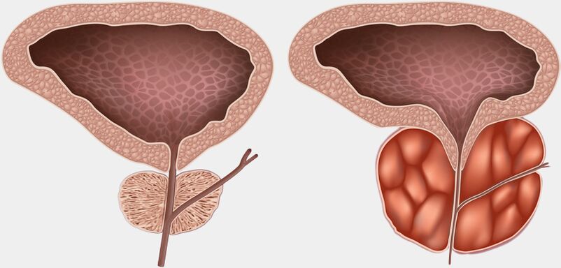 gesunde und entzündete Prostata mit Prostatitis