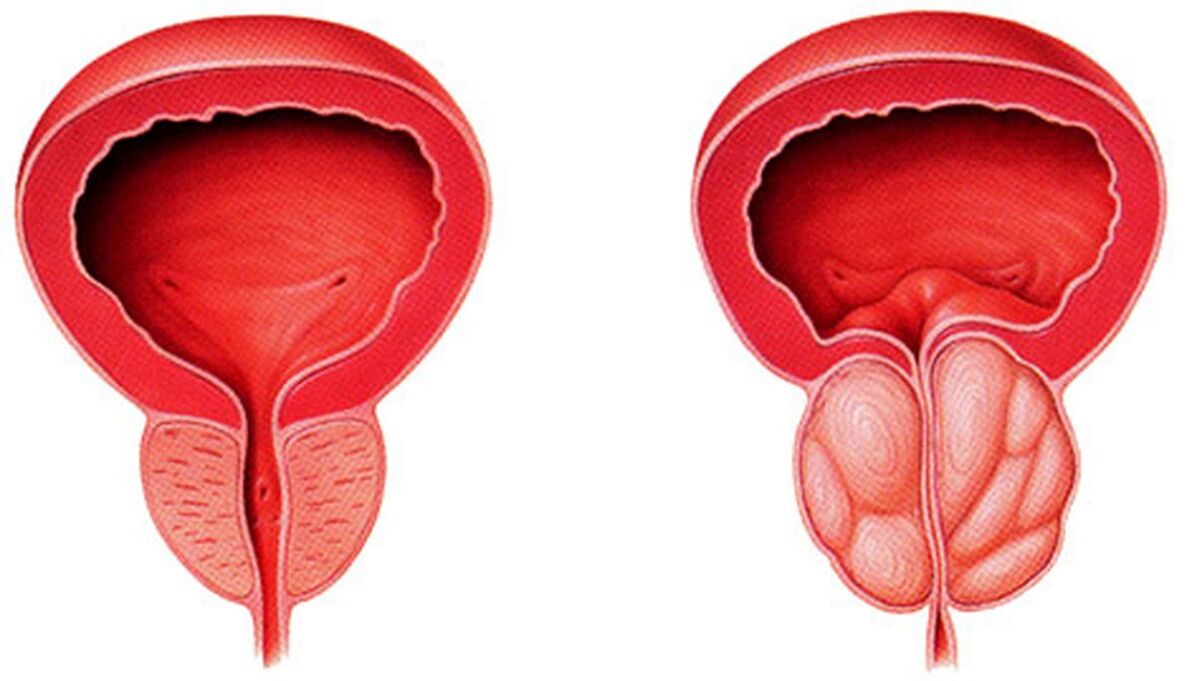 gesunde und entzündete Prostata mit Prostatitis