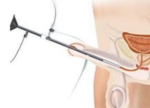 Instillationen bei Prostatitis