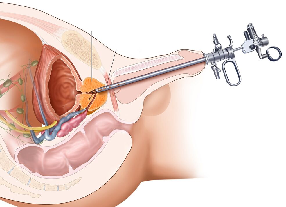 Die transurethrale Resektion der Prostata ermöglicht es Ihnen, die betroffenen Teile des Organs zu entfernen