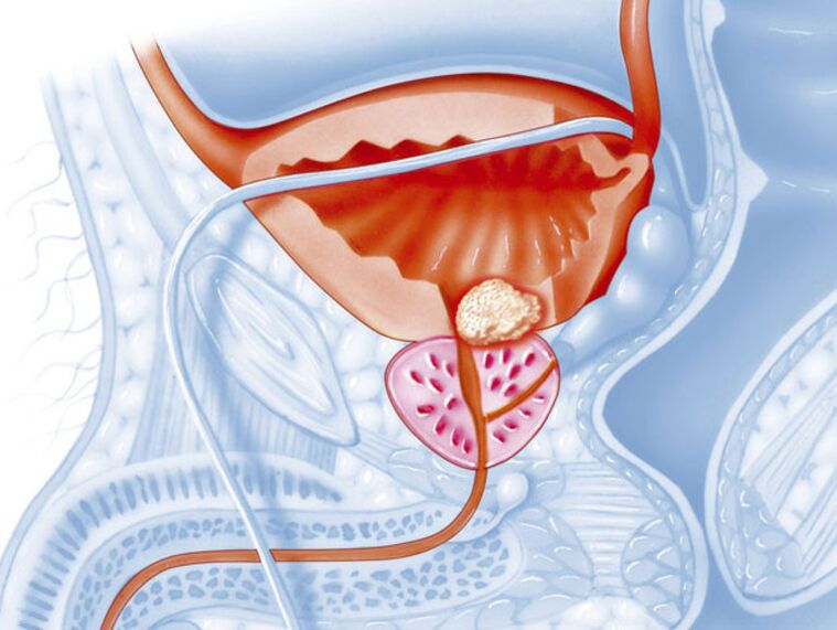 Bei chronischer Prostatitis ist das Lumen der Harnröhre verengt, was den Urinfluss erschwert. 